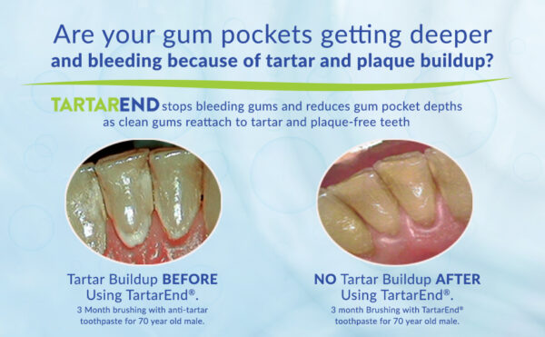 Best Toothpaste For Plaque And Tartar Removal Remove Tartar, Plaque & Dental Calculus | TartarEnd® Toothpaste